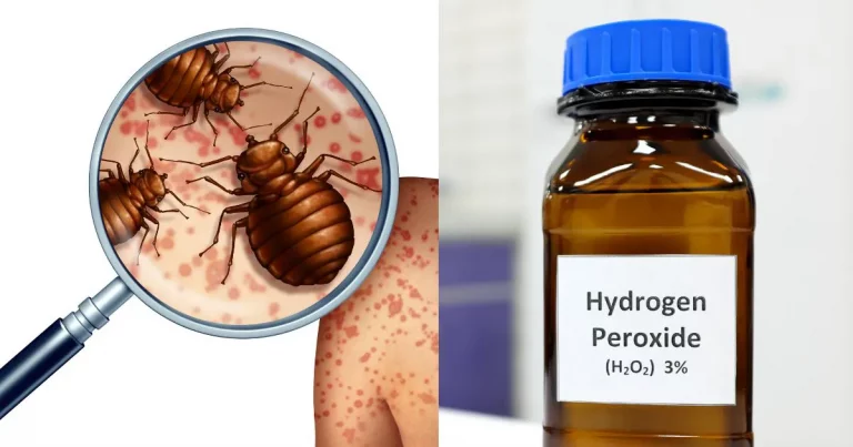 Does Hydrogen Peroxide Kill Bed Bugs? (2 Crazy Steps!)